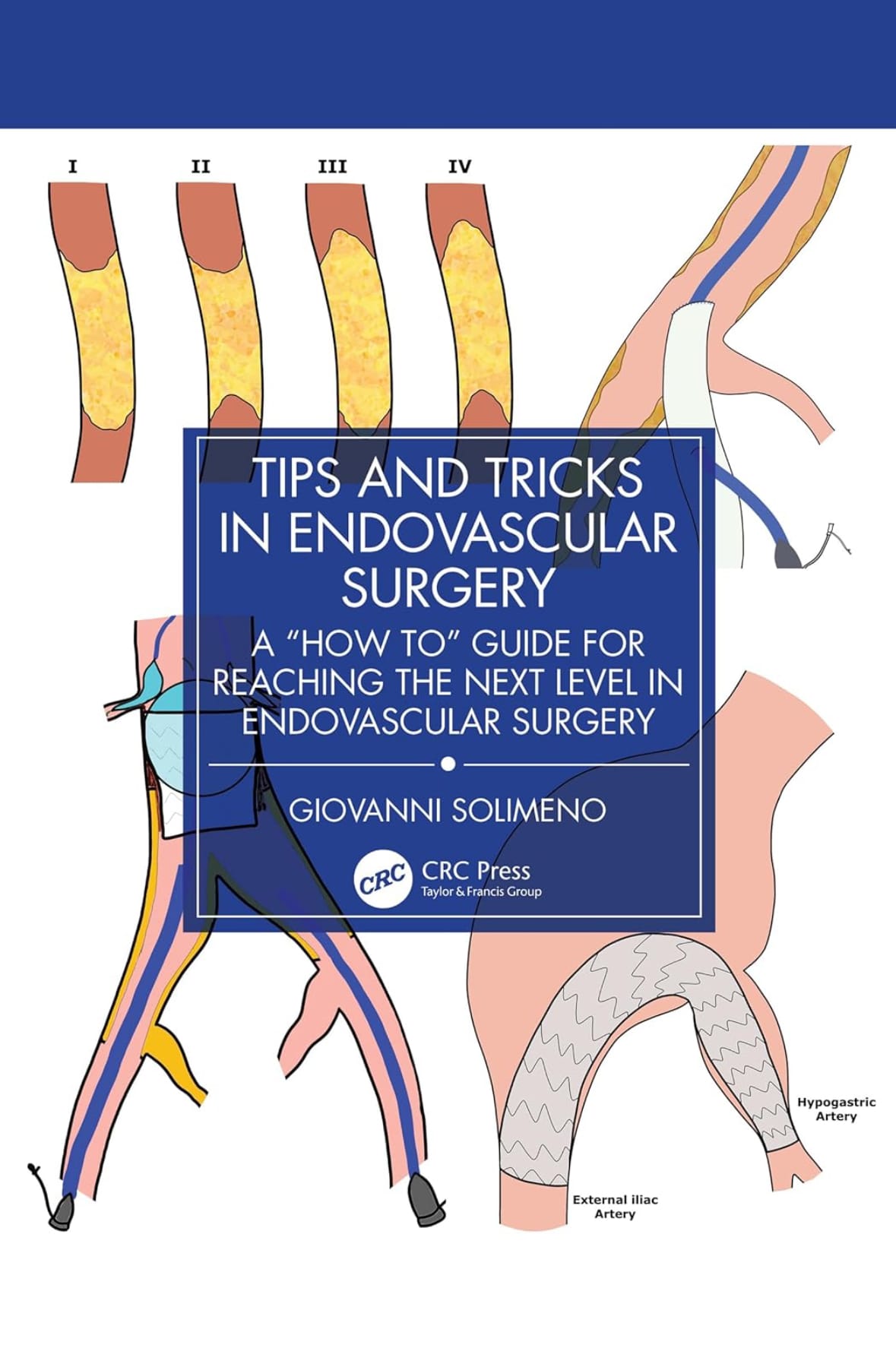 Tips & Tricks in Endovascular Surgery - The Book