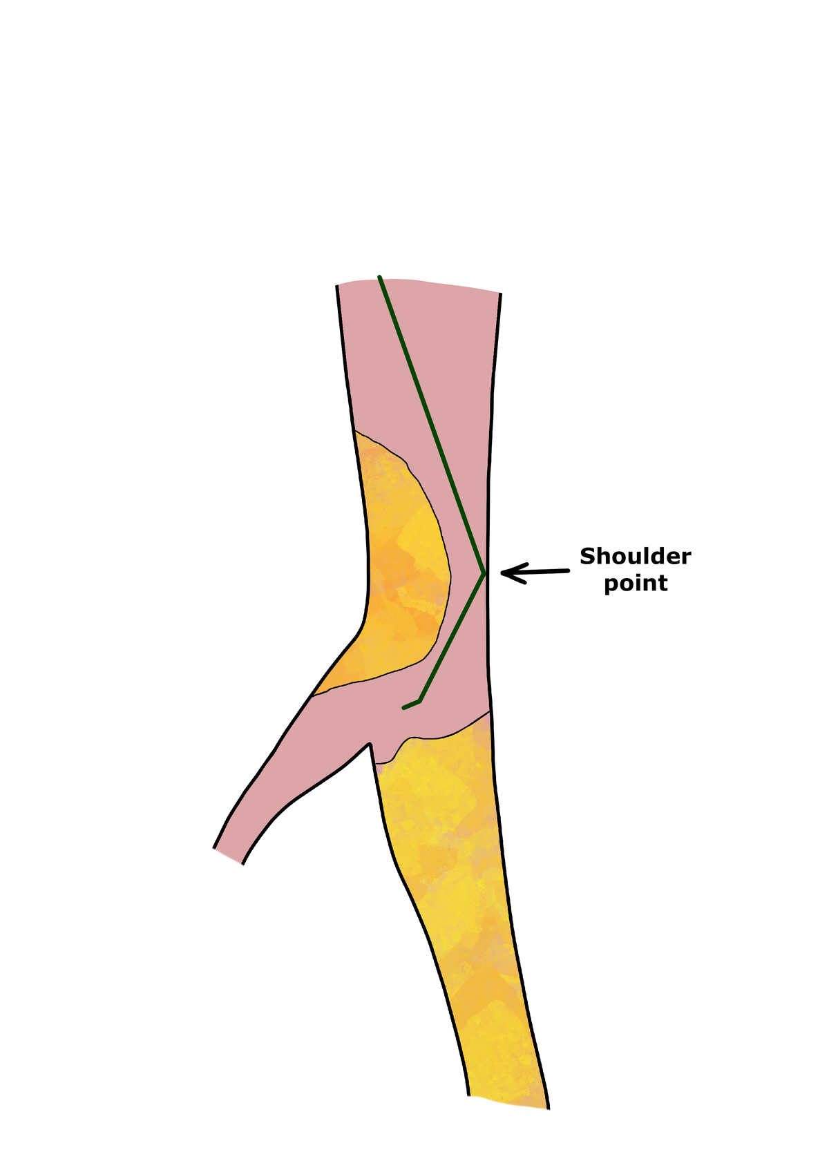 The Importance of Guidewire Bending: The Shape That Takes You Everywhere